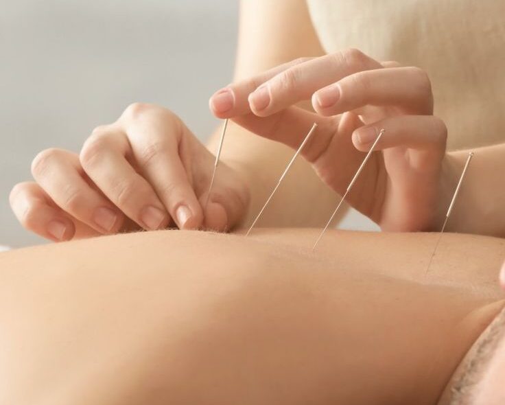 dry needling best solution for muscle pain